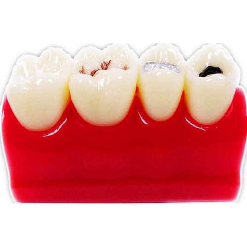 1pcs Dental Pit Fissure Caries Sealant Study Model Silver Amalgam Teach Study