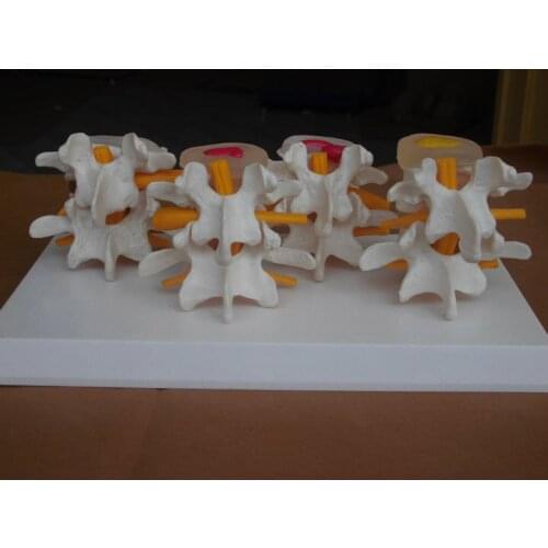 Human skeleton model lumbar disc disease model spine model lumbar bone lesions Model