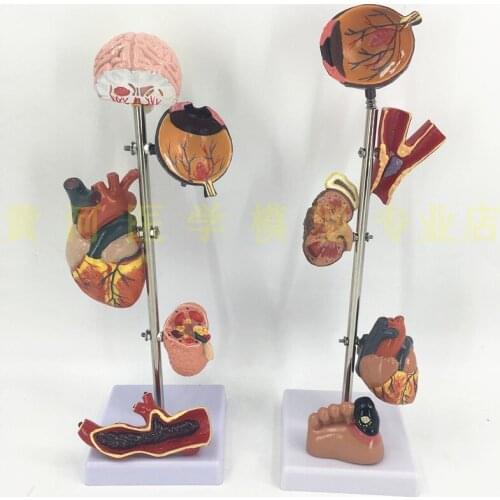 Diabetes complications display model Hypertension pathological display model