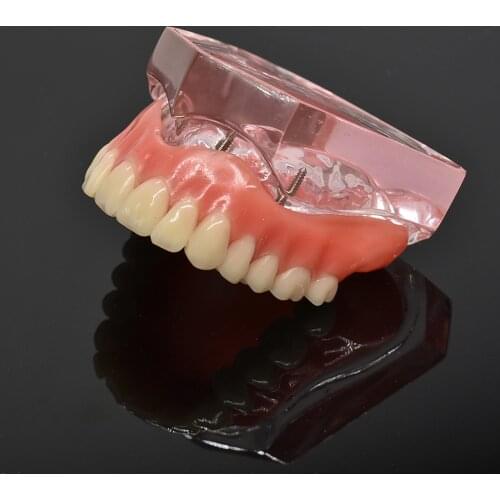 Dental Overdenture Teeth Model Removable Interior Mandibular Lower Teeth Model Mandibular with Implant for Tooth Teaching Study
