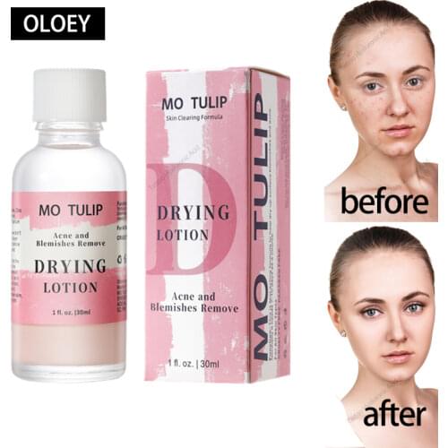 MO TULIP 30ml Effective Squeezer Acne Treatment Mario Badescu Drying Lotion Face serum Anti Acne Serum Pimple Blemish Removal