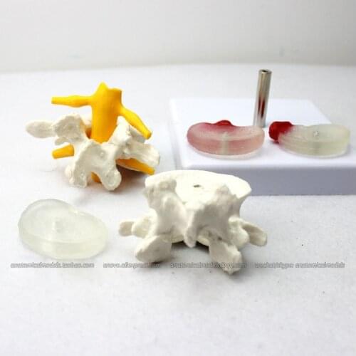 CMAM/12391 slipped disk,Disc herniation, Medical Backbone Anatomical Human Model