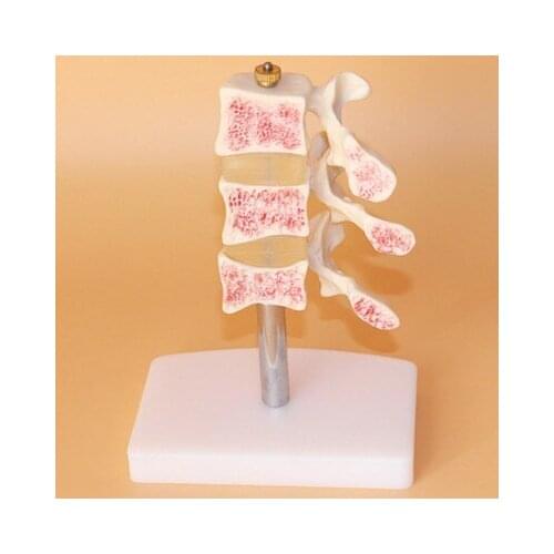 1:1Vertebral Disease model Osteoporosis free shipping