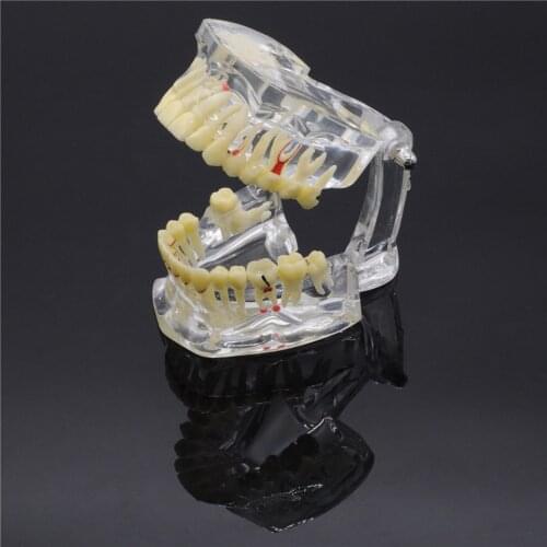 1 X Dental Implant Disease Tooth Pathological Extrusion Missing Teeth Model New For Dentistry Lab