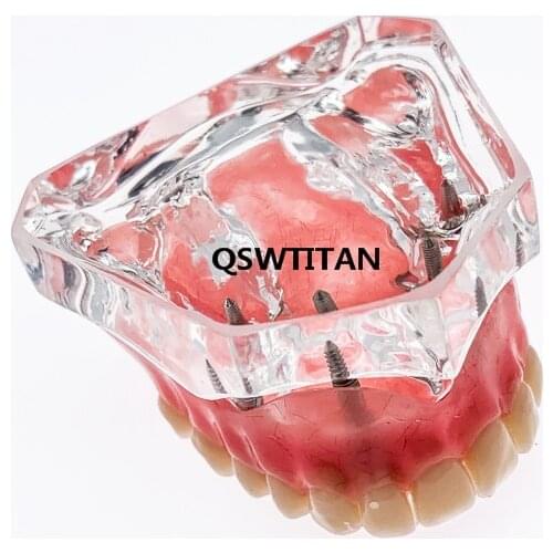 Dental Clear Acrylic Upper Teeth Model Overdenture Superior 4 Implants Maxillary Demo Model 6001