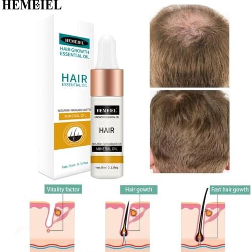 Hemeiel Hair Loss Remedies