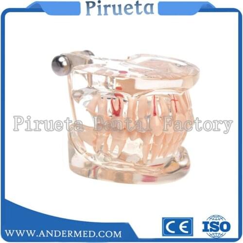 1pcs Dental Implant Disease Teeth Model With Restoration Bridge Tooth Dentist For Medical Science Dental Disease Teaching Study