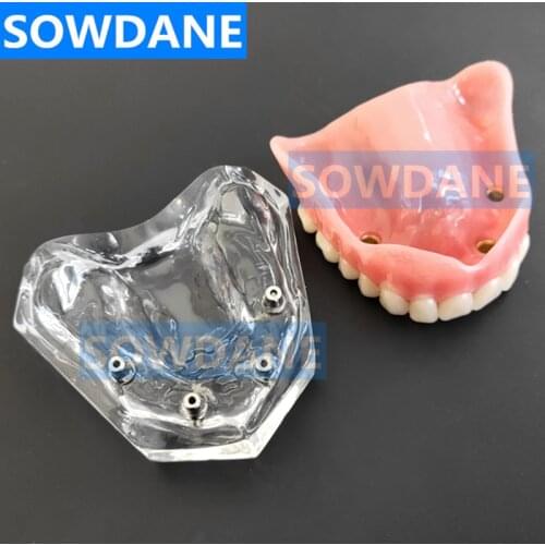 Dental Overdenture Upper Anterior Maxillary with 4 Implant Restoration Teeth Study Teach Model