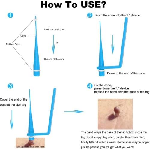 Face Skin Tag Removal Tool skin tag remover Kill mole remove Medical Skin Tag wart treatment Acne Remover Cleansing Micro Band