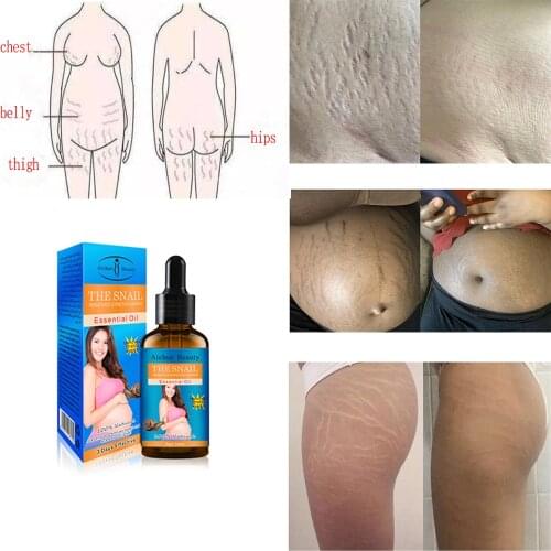Australia Stretch Marks Snail Repair Oil Remove Stretch Scar Removal Strech Mark Remover Fat lines Remove