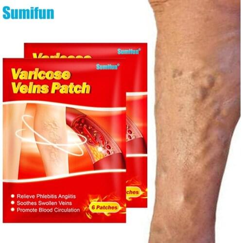 Sumifun 6pcs/bag Varicose Veins Patch Leg Vasculitis Phlebitis Spider Leg Medical Plaster Angiitis Removal Chinese Herbal Patch