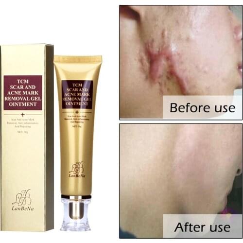 2019 Acne Scar Cream Ginseng Essence Anti Acne Remover Cream Face Care Makeup Spots Stretch Marks Remove Scar Product