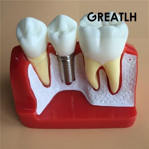 Dental Implant Analysis Crown Bridge dental demonstration model Dentist Tools Study Model