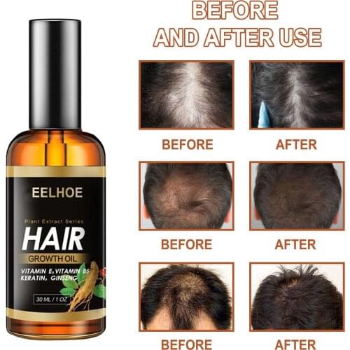 Hair Growth Serum For Thinning Hair Adult,herbal Essential Oil Ginger Fast Essential Oil Preventing Hair Loss Liquid 30ml