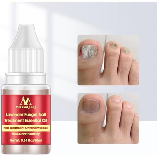 Fungal Nail Treatment Serum Onychomycosis Paronychia Anti-Fungal Nail Infection Herbal Toe Fungus Foot Repair Essence Care 10ml