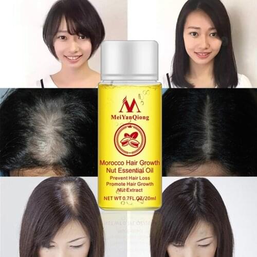 Faster Grow Hair Ginger Hair Loss Treatment Oil Hair Growth Shampoo Stop Natural Andrea Hair Growth Products Ginger
