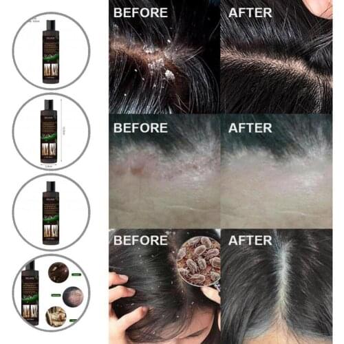 Anti-dandruff Shampoo Delicate Texture No Additives Non-irritating Hair Dandruff Removal Shampoo
