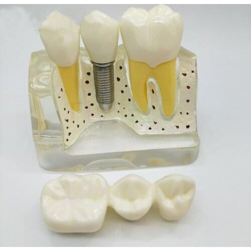 1pc dental demonstration teeth Removable model implant analysis Teaching Study Implant Dental Teach Dental Crown Bridge