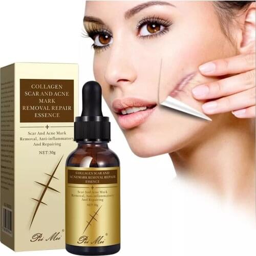 Scar Removal Serum Acne Scars Cream Stretch Marks Surgical Scar Burn For Body Pigmentation Corrector Acne Spots Repair Care 30g