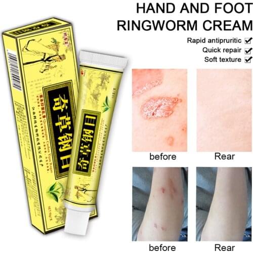 Advanced Body Psoriasis Cream For Dermatitis Eczema Natural Treatment Pruritus Skin Care Psoriasis Ointment Herbal Creams 15g/pc