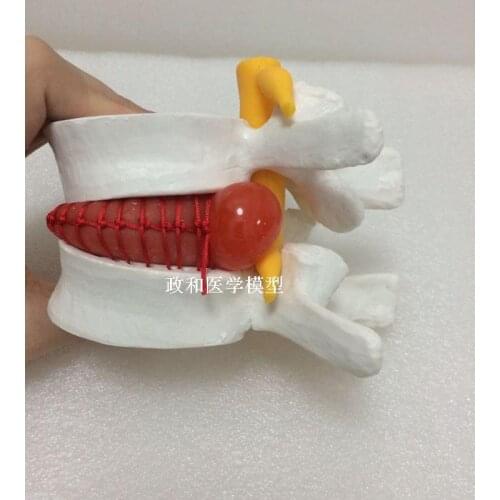 2016 Human lumbar disc herniation model demonstration model of lumbar vertebral spine model