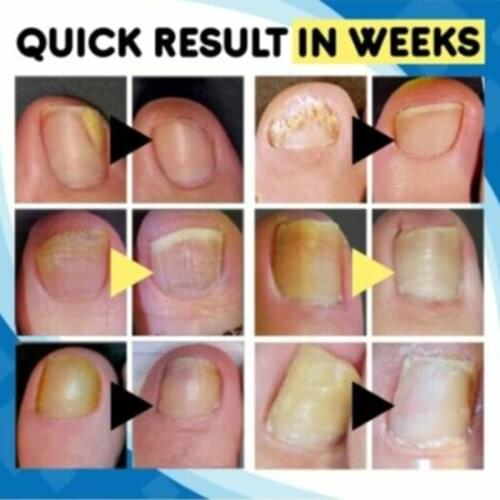 2021 Blu-Ray Acne Pen Eye Massager Home Treatment Set Relieve Eye Strain Dark Circles Eye Bags Dry Eye SSwell