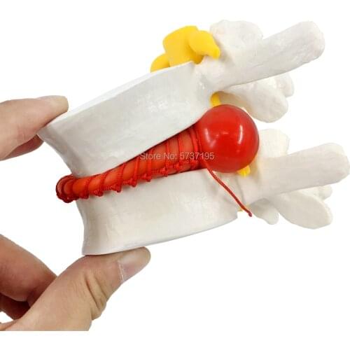 Human anatomy skeleton spine model with nerve Disc herniation teaching tool medical supplies free shipping for USA