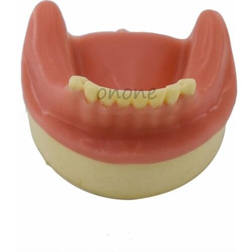 1pcs Teeth Model with Gingiva Bone Imitating Oral Teaching Aids Dental Implant Placement Exercise Practice model