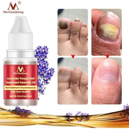 10ml Fungal Nail Treatment Serum Herbal Repair Onychomycosis Product Anti-Fungal Paronychia Fungus Infection Essence Care Health