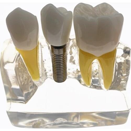 2018 Clear Dental Demonstration Study Teeth Model for Implant Analysis Crown Bridge Model