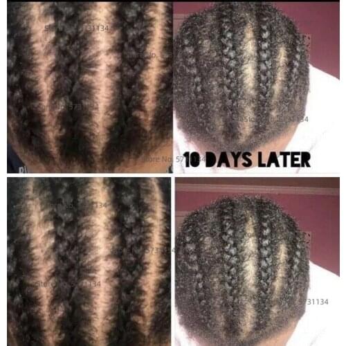 Anti-itch hair Growth Braid Oil, Itchy scalp, 30 ML