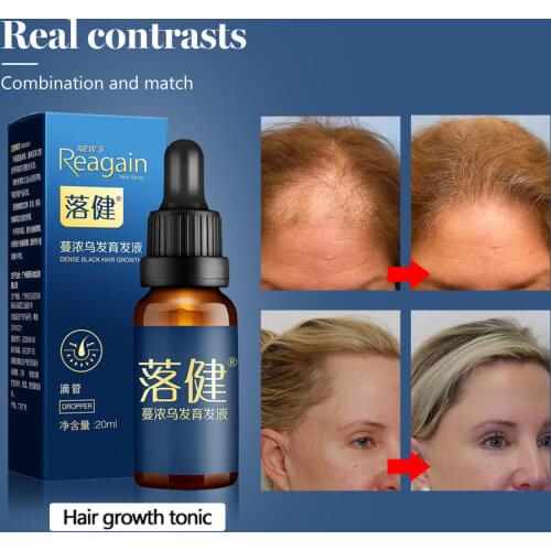Hair Growth Essence Oil Anti Hair Loss Products for Hair Growth Treatment Natural Hair Serum Thickener Hair Care Solutions