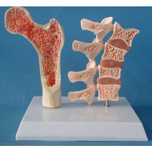 2 parts PVC Human Anatomical Model Osteoporosis Femur Leg Bone Spinal Section Specimen Diseased Lumbar Spine