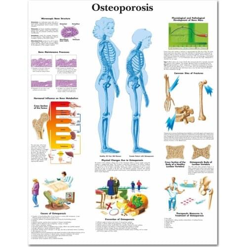 WANGART Osteoporosis Chart Poster Print Canvas Painting Wall Pictures for Medical Education Doctors Office Classroom no frame