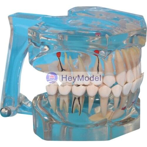 HeyModel Adult Teeth Model Transparent tooth pathology 2.5 times magnified