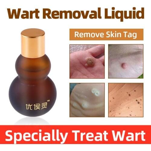 Hou Warts Treatment Antibacterial Liquid Medical Remove Meat Thorn or Skin Tag Release Foot Or Hand Body Warts