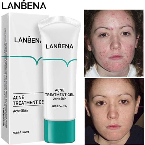 LANBENA Acne Cream Gel Remove Acnes Pimples Whitening Acne Scars Spots Oil Control Purify Pores Moisturizing Oily Skin Care 20g