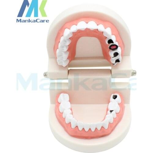 Standard Tooth Teaching Giant Dental Dentist Teeth Model Child Kidtraining Model Disease Teeth Medical Typodont Demonstration