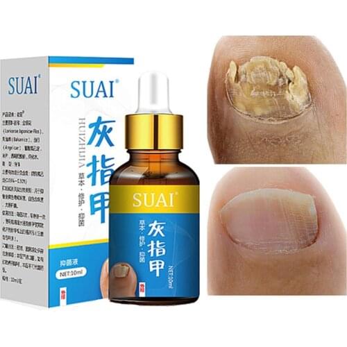 Nail Fungal Treatment Feet Care Essence Nail Foot Whitening Toe Nail Fungus Removal Gel Anti Infection Paronychia Onychomycosis