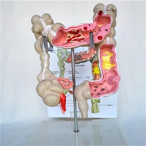 Human colorectal lesion model Intestinal organs Teaching demonstration of medical pathology