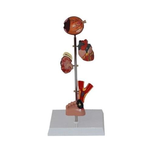 Diabetes target organ foot heart kidney model free shipping