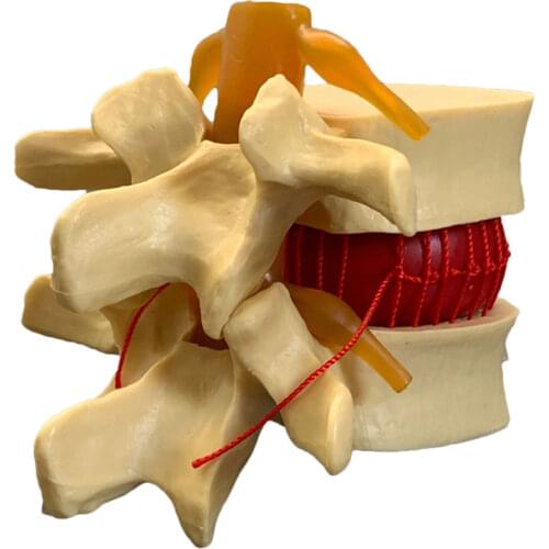 Anatomical Human Lumbar Vertebrae Degenerative Lumbar Disc Herniation Demonstration Model Human Spine Model - White, Yellow