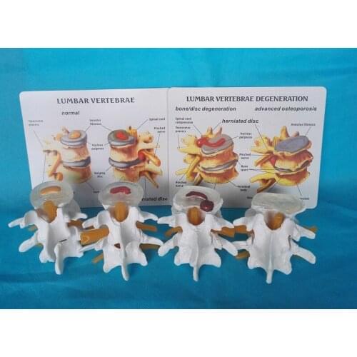 Lumbar vertebrae degeneratation advanced osteoporosis spinal skeleton model