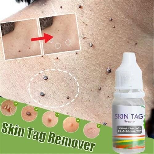 Skin Tag Remover Pen 12 hours Tu kill Medical Tu kill Remover Skin Tag Mole & Genital Wart Remover Foot Corn Removal Pen