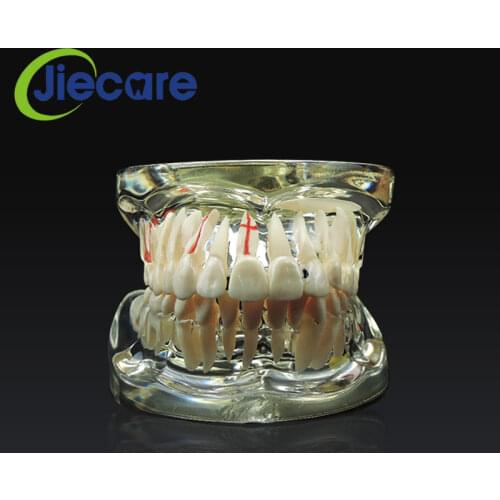 1 PC New Dental Study Tooth Transparent Adult Pathological And Disease Teaching Teeth Model Removable Dental Lab Equipment