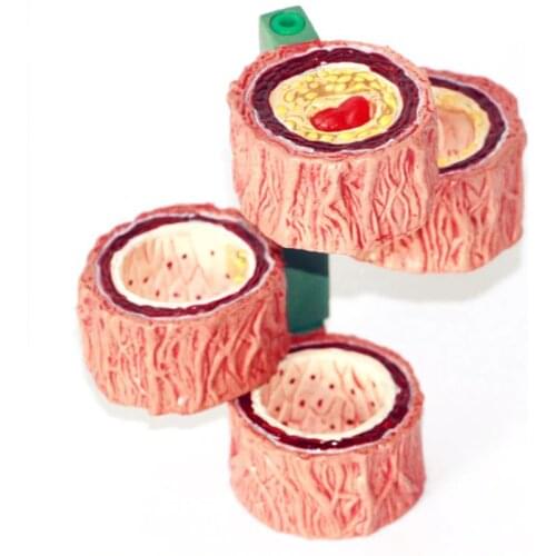 Human Atherosclerosis Model Thrombosis Model Artery Model Thrombosis Evolution Anatomy Medical Teaching Tool