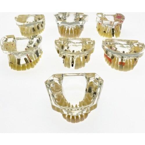 Teeth model with bridge and caries Upper Jaw Lower Jaw Teeth model Dental implant model