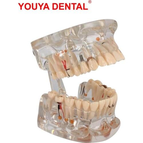 1pcs Transparent Dental Model Teeth Restoration Bridge Tooth Implant Model For Studying Teaching Medical Science Detal Products