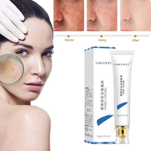 Powerful Whitening Freckle Cream Remove Melasma Acne Spot Pigment Melanin Dark Spots Pigmentation Moisturizing Gel Skin Care