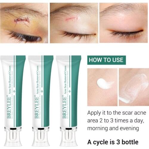 Scar Gel Cream Acne Spots Remover Serum Face Skin Burns Repair Skin Care